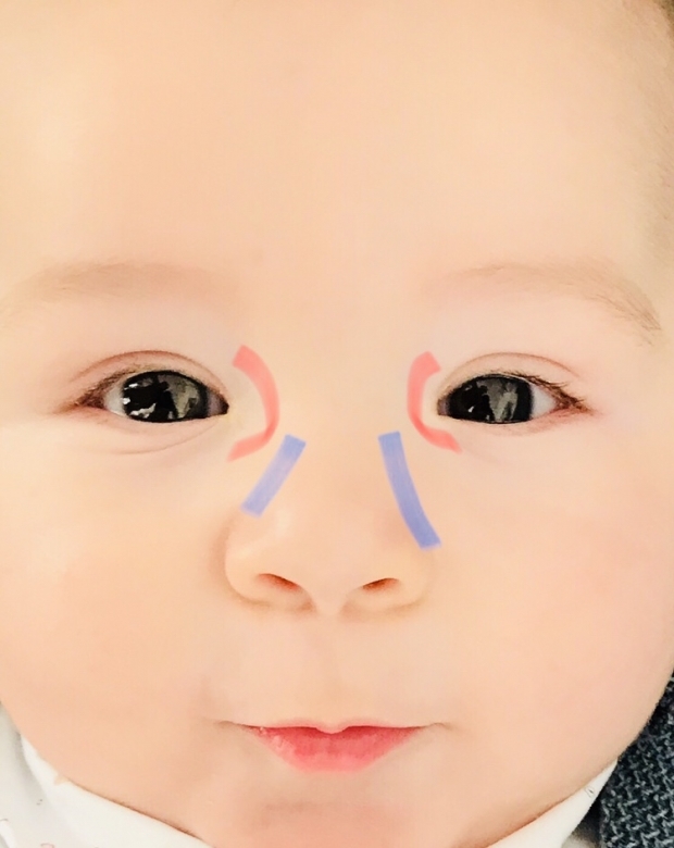 Массаж глазного заусенца у детей