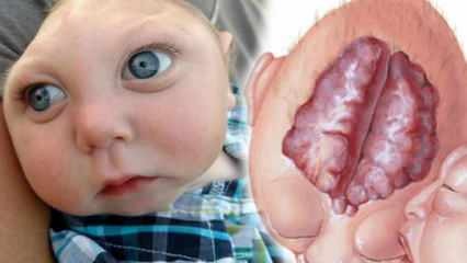 Что такое анэнцефалия? Каковы симптомы анэнцефалии у младенцев и детей? Анэнцефалия вызывает ...