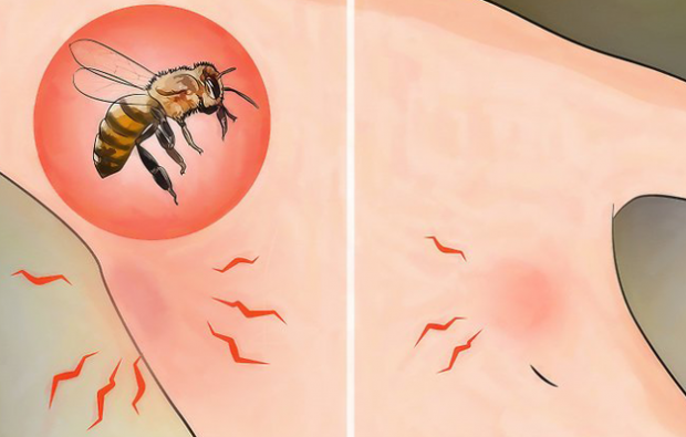 Что такое аллергия на пчел и каковы симптомы? Естественные методы, которые хороши для укусов пчел