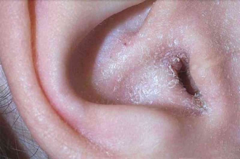 Что вызывает шелушение за ухом и как оно проходит? Окончательное решение от заушной экземы ...