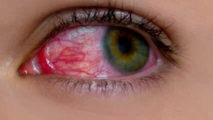 Что вызывает аллергию на глаза? Каковы симптомы аллергии на глаза? Что хорошо при аллергии на глаза? 