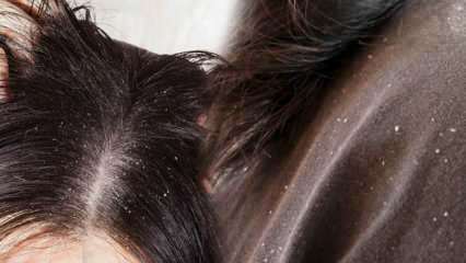 Как проходит перхоть и что хорошо для волос от перхоти? 5 самых быстрых и эффективных методов удаления перхоти