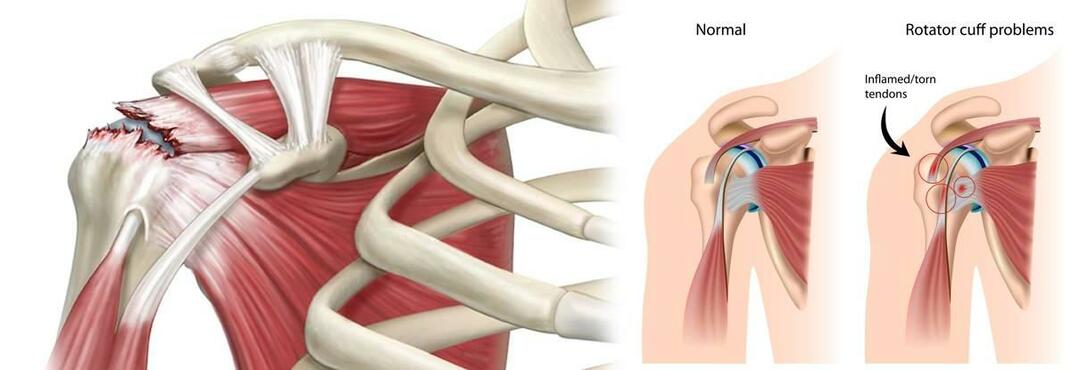 Почему возникает разрыв плеча? Как лечить разрыв плеча?