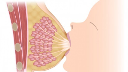 Что такое мастит (воспаление груди)? Симптомы мастита и лечение при грудном вскармливании