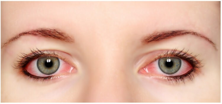 Есть ли аллергия на тушь и подводка для глаз?