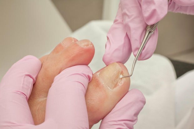 Что вызывает вросшие ногти на ногах и каковы симптомы? Естественные способы, которые хороши для вросших ногтей ...