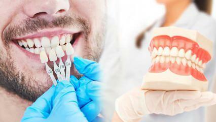 Почему на зубы накладывают циркониевые виниры? Насколько долговечно циркониевое покрытие?