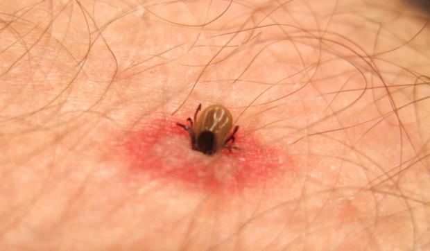 Что такое укус насекомого? Симптомы укусов насекомых! Натуральный метод от комариных укусов