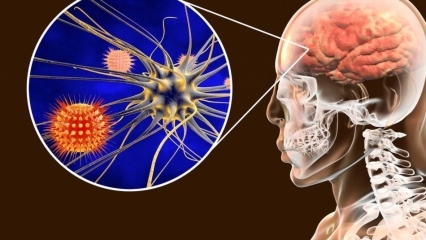 Что такое менингит и каковы симптомы? Есть ли лечение менингита?