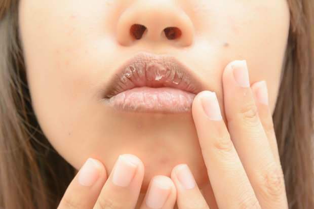 анемия вызывает сухость губ