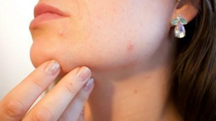 Что такое рак кожи (меланома)? Каковы симптомы меланомы и есть ли лекарство?