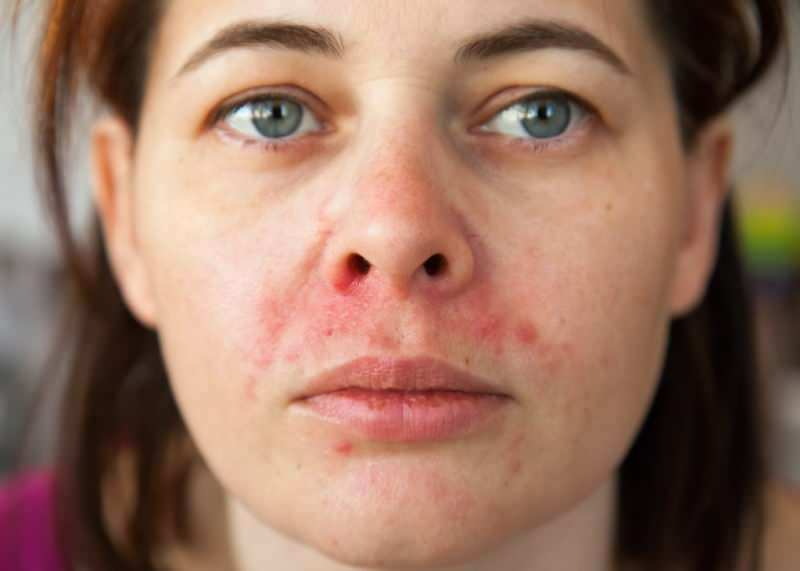 Почему прыщи появляются вокруг губы? Как лечится периоральный дерматит?