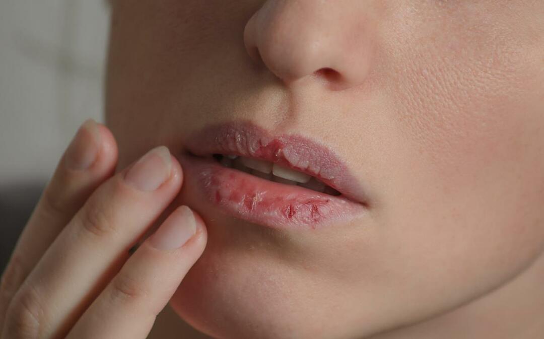 Что вызывает темные губы? Как лечат потемнение губ или синяки?