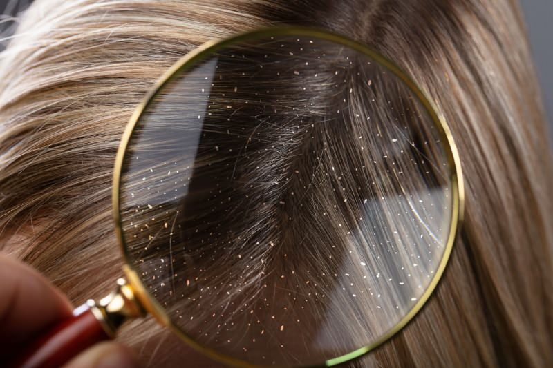 Как проходит перхоть и что хорошо для волос перхоти? 5 самых быстрых и эффективных средств от перхоти
