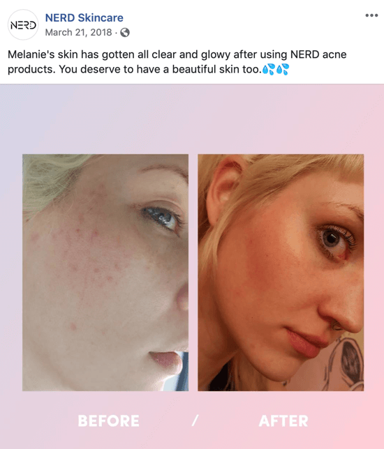 Пример того, как Nerd Skincare использовал изображение до и после, чтобы создать пост с изображением для социальных сетей, который стимулирует покупки их продуктов.