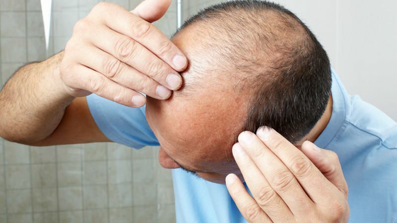 Предотвращает ли пересадка волос гусль?