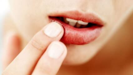 Что хорошо для растрескивания губ?