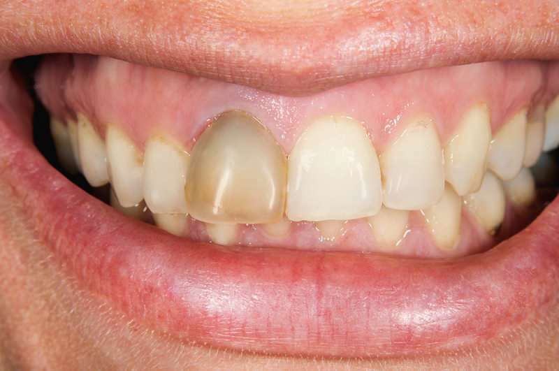 потемнение зубов иногда может концентрироваться на одном зубе