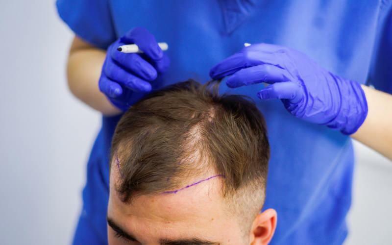 Допустимо ли пересаживать волосы при лечении выпадения волос? Что такое протез волос? Мешают ли протезные волосы гуслю?