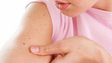 Что такое рак кожи (кожи) и каковы его симптомы? Способы понять рак кожи