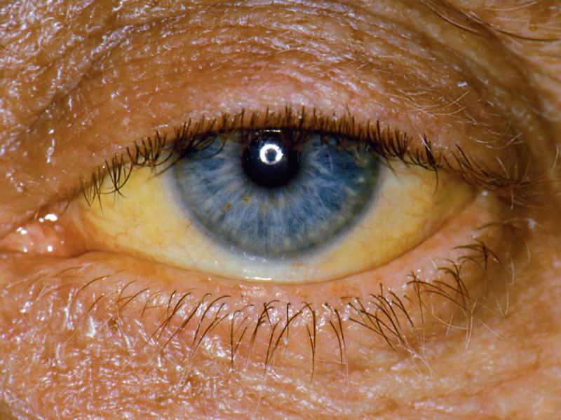 высота на уровне билирубина вызывает желтый цвет на глазах и коже