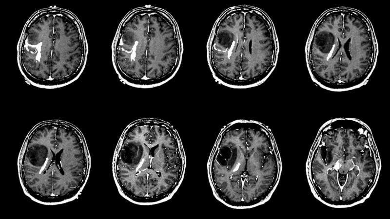 Что вызывает опухоль головного мозга? Каковы симптомы опухоли головного мозга? Сложно ли лечение опухоли головного мозга?