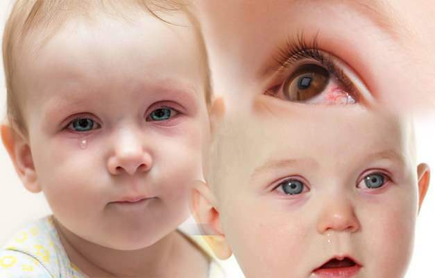 Почему у младенцев в глазах течет кровь? Как проходит глазное кровотечение у новорожденного ребенка?