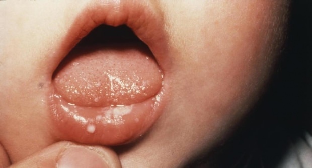 Как болит рот у детей?