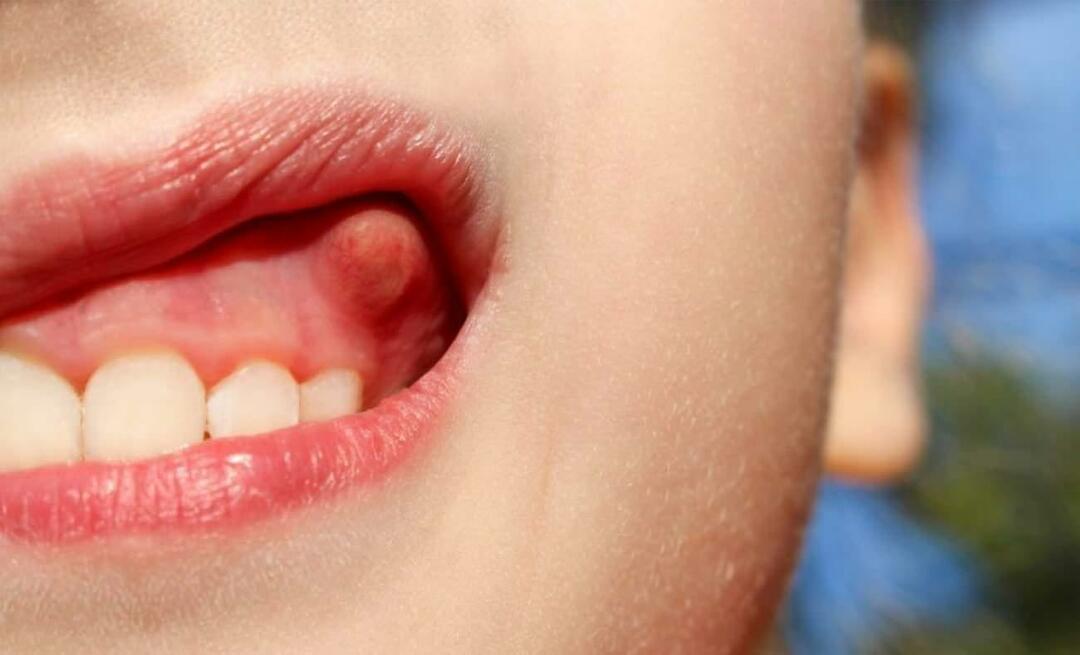 Почему абсцедирует зуб и каковы симптомы? Зубной абсцесс, как его лечить?