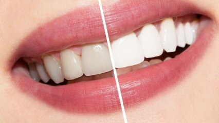 Какие рекомендации для белых зубов? Отбеливание зубов естественно вылечить в домашних условиях ...