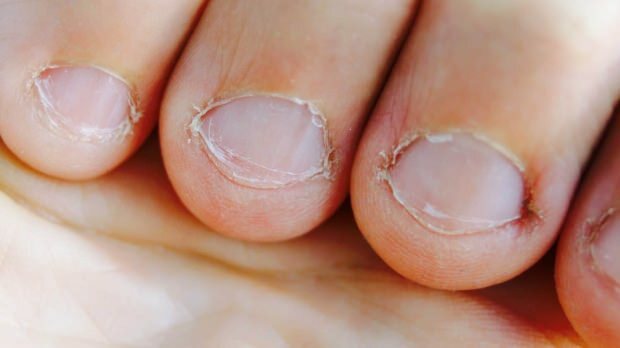 Что такое болезнь поедания ногтей? Какие заболевания вызывает употребление ногтей?