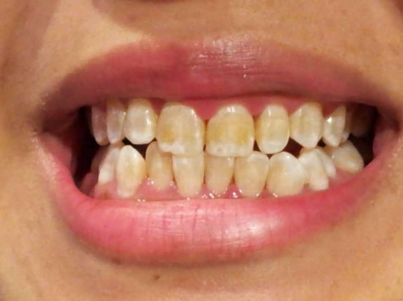 Почему нижняя часть зубов темнеет? Отбелите зубы за неделю этой смесью!