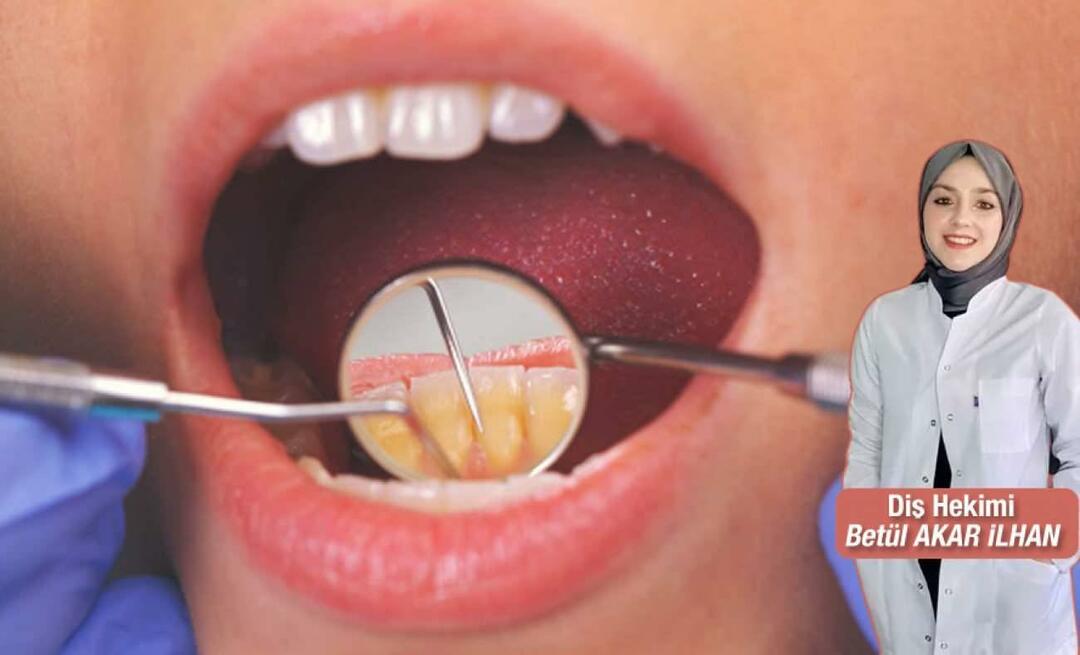 Что делать, чтобы не было зубного камня? Каковы преимущества зубного скалирования?