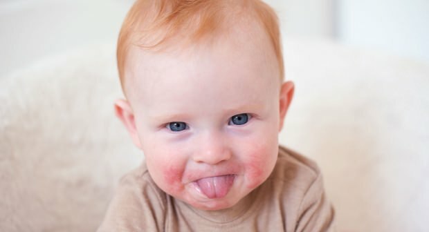 Внимание у малышей с красными щеками! Синдром пощечины щеки и его симптомы