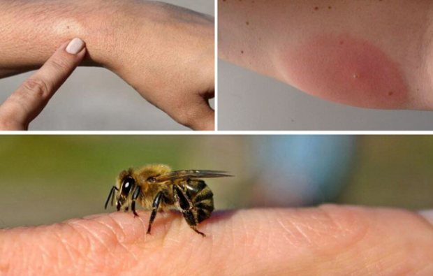 симптомы аллергии на пчел