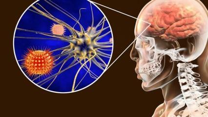Что такое менингит и каковы его симптомы? Есть ли лечение менингита?